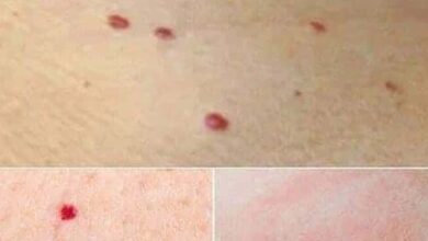 Photo of Red Dots on Your Skin: Causes and What They Could Mean