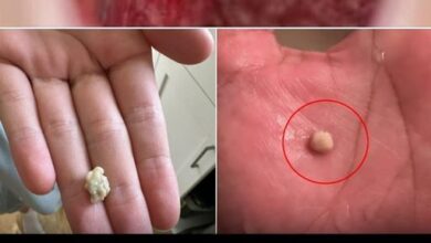 Photo of Here’s what you need to know about tonsil stones – the weird pimple-like growths in your throat